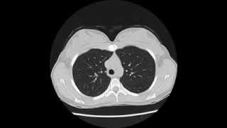 Normal Chest CT - using 