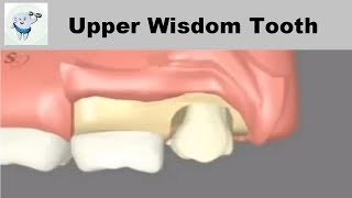 Upper Wisdom Tooth Removal