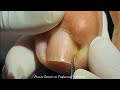 UNHA ENCRAVADA COM ONICOFOSE (INGROWN NAIL WITH ONYCHOPHOSIS) - PODÓLOGO MAURÉLIO