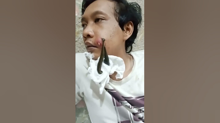 Terapi Lintah, Pengobatan herbal, alternatif #shorts #shortsvideo #shortsdund