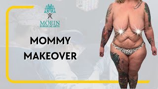 Desirable Results: Mommy Makeover by Dr. Babak Moein