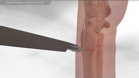 Surgical Fixation of Wrist Fractures