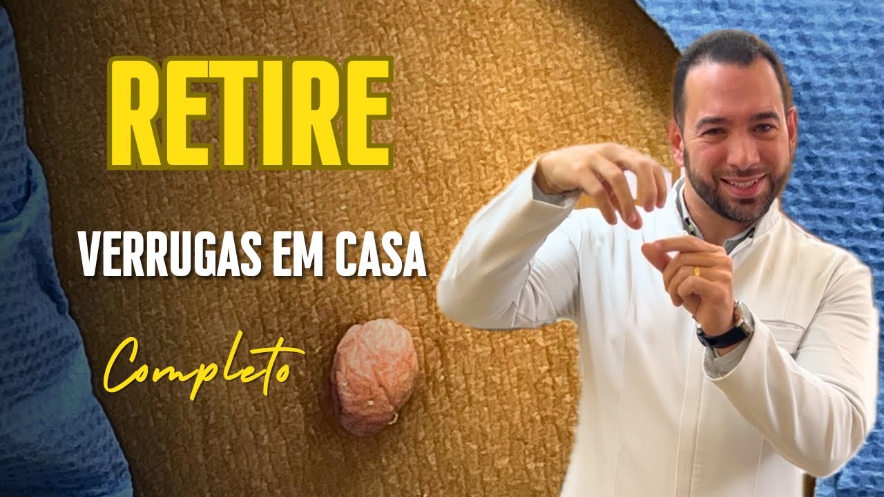 Como retirar verrugas em casa, fibroma mole e acrocórdons. Sem dor. Técnica caseira atualizada.