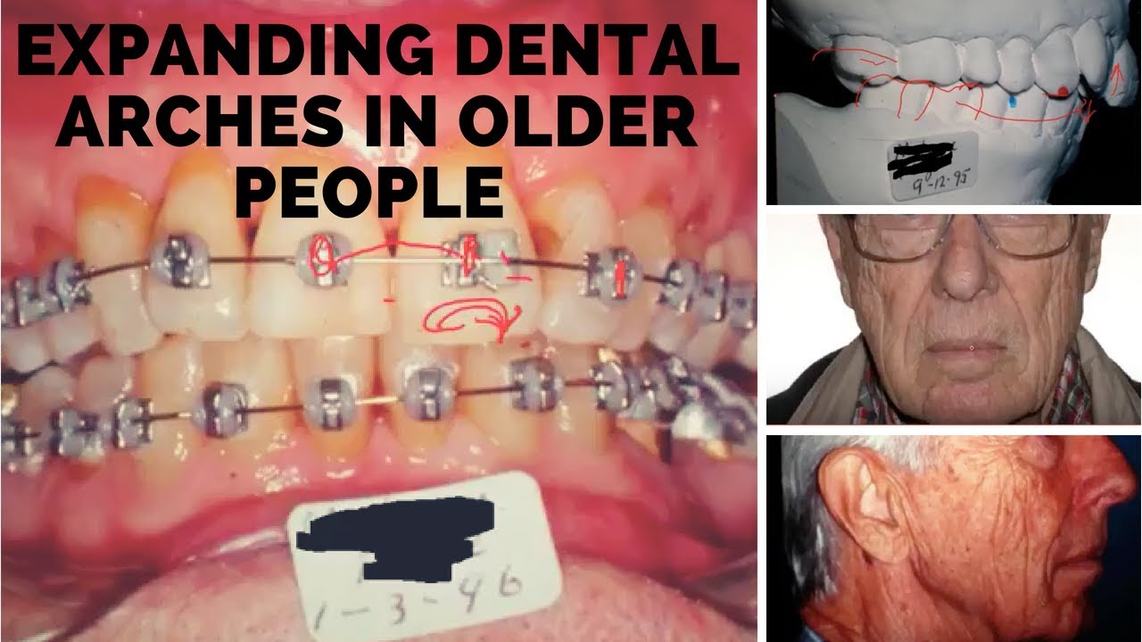Expanding dental arches in older people- 79 years old when we started the case !!!