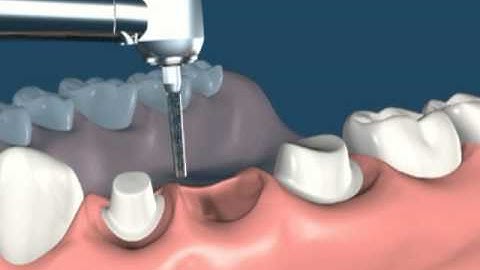 Process of 3 unit bridge