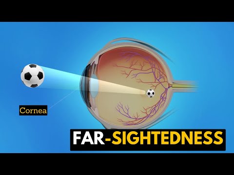 Video: Prečo je ďalekozrakosť problémom?