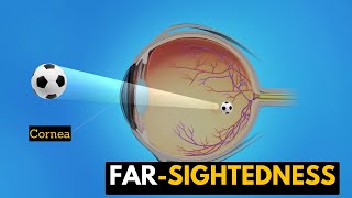 Far-sightedness, Causes, Signs and Symptoms, Diagnosis and Treatment.