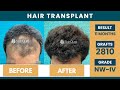 Hair Transplant in Delhi | Best Results | Hair Transplant Cost in Delhi | SkinQure