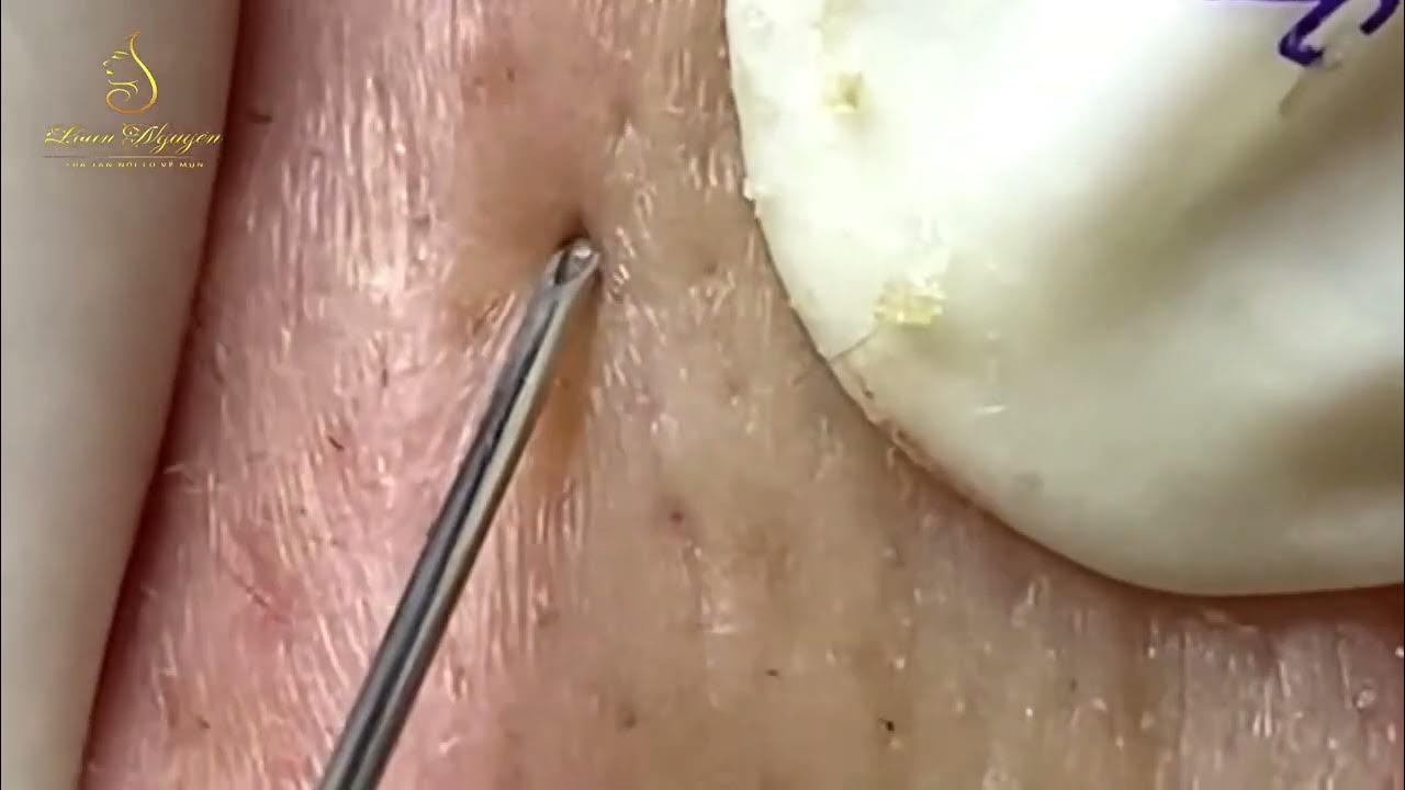 The Most Disgusting Pimple Popping Videos on the YouTube