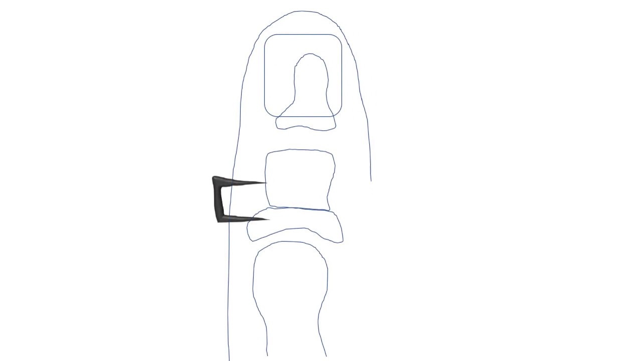 Proximal Akin - PrePodiatryClinic101