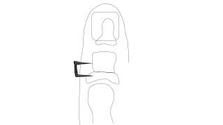 Proximal Akin - PrePodiatryClinic101