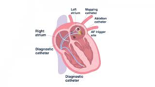 Catheter Ablation - How is it Catheter Ablation performed with Dr. Davis Schwartzman