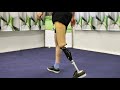Knee exarticulation amputee with Endolite KX06