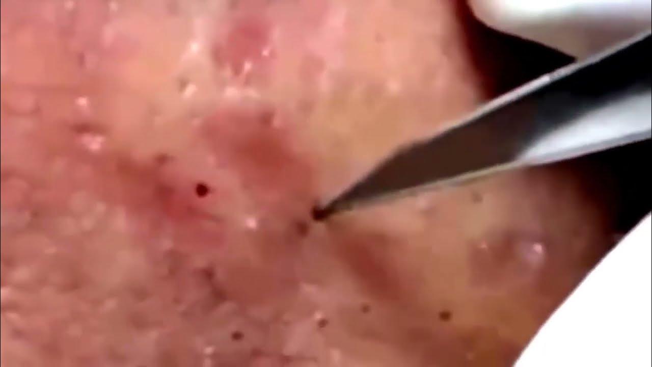 Blackheads Removal Acne Treatment and Very Satisfying Satisfying