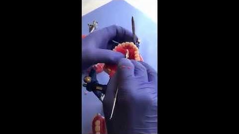 Waxing up Complete Dedntures