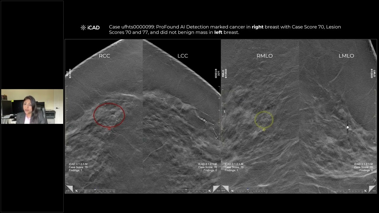 Case 3: 66 year old woman with scattered fibroglandular densities for screening