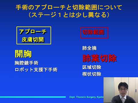 肺癌のガイドラインを解説します（ステージ２非小細胞癌治療）