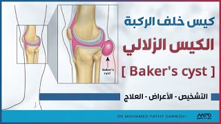 كيس زلالي خلف الركبة ( Baker's Cyst )  - الأعراض والعلاج | د. محمد فتحي درويش