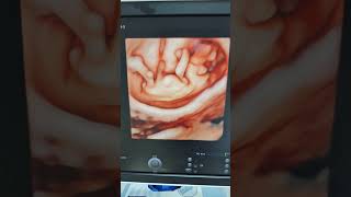 #ultrasound#4dultrasound 4d #baby #12weeks pregnancy