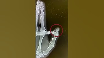 EpiPen Gone Wrong 😨