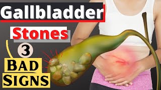 Gallbladder Stone: 3 Bad Signs  - By Doc Willie Ong (Internist and Cardiologist)