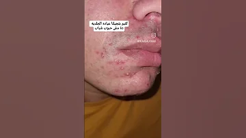حبوب الوجه سببه البكتيريا د منال فؤاد 