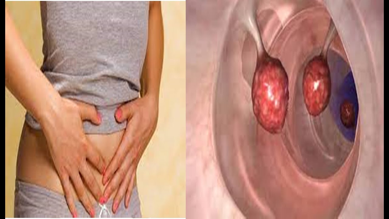 Es peligroso un pólipo endometrial