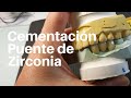 PUENTE Dental de ZIRCONIA👅Posterior Cementación #Puentezirconia #Puentedental