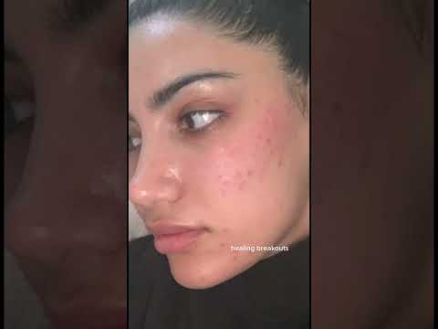 my skin transformation