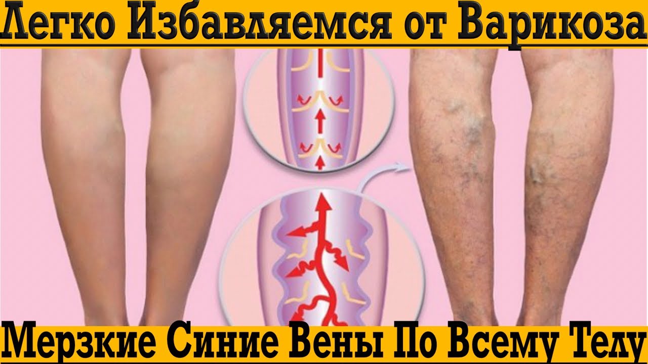 Достал ВАРИКОЗ?! Легко избавляемся от мерзких синих вен по всему телу с этим секретом!
