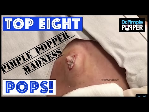 EIGHT POPS For You - PIMPLE POPPER MADNESS!!