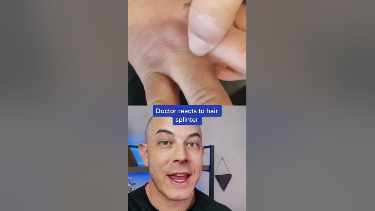 Derm reacts to crazy hair splinter! #barber #hairsplinter #dermreacts #splinterremoval