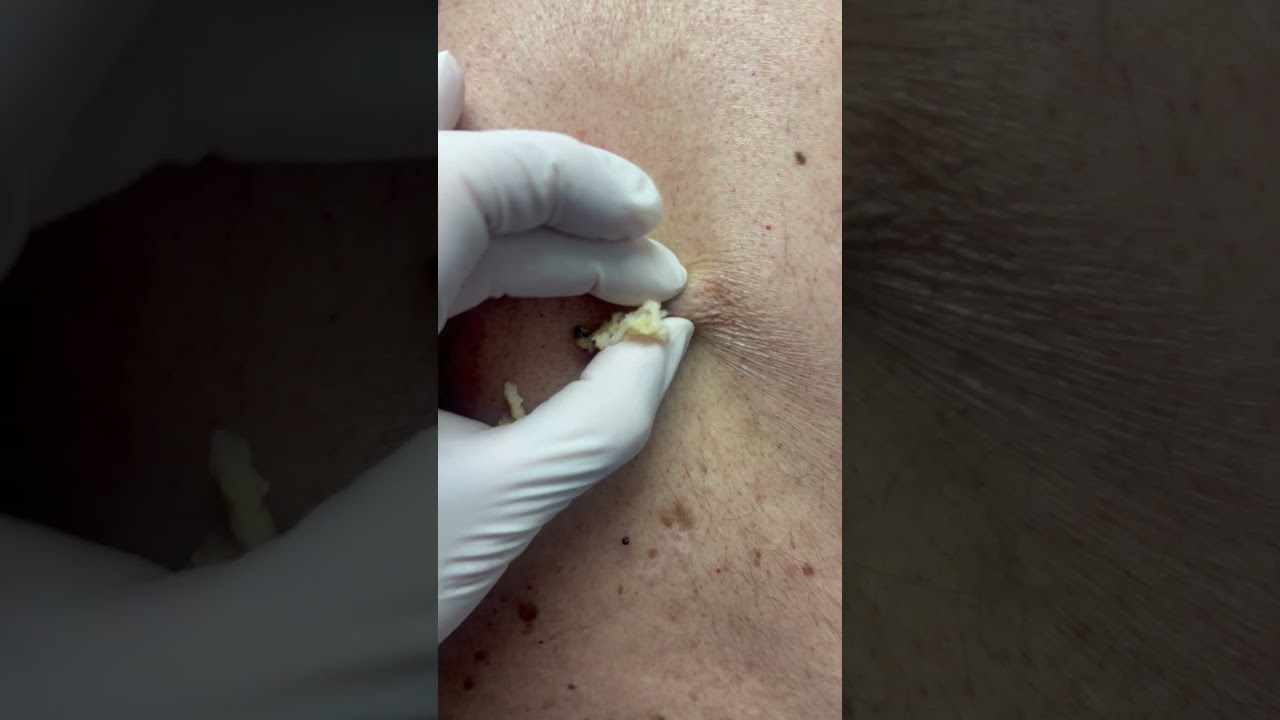Simple Cyst Expression 💦 by Dr. H.L. Greenberg at Las Vegas Dermatology®