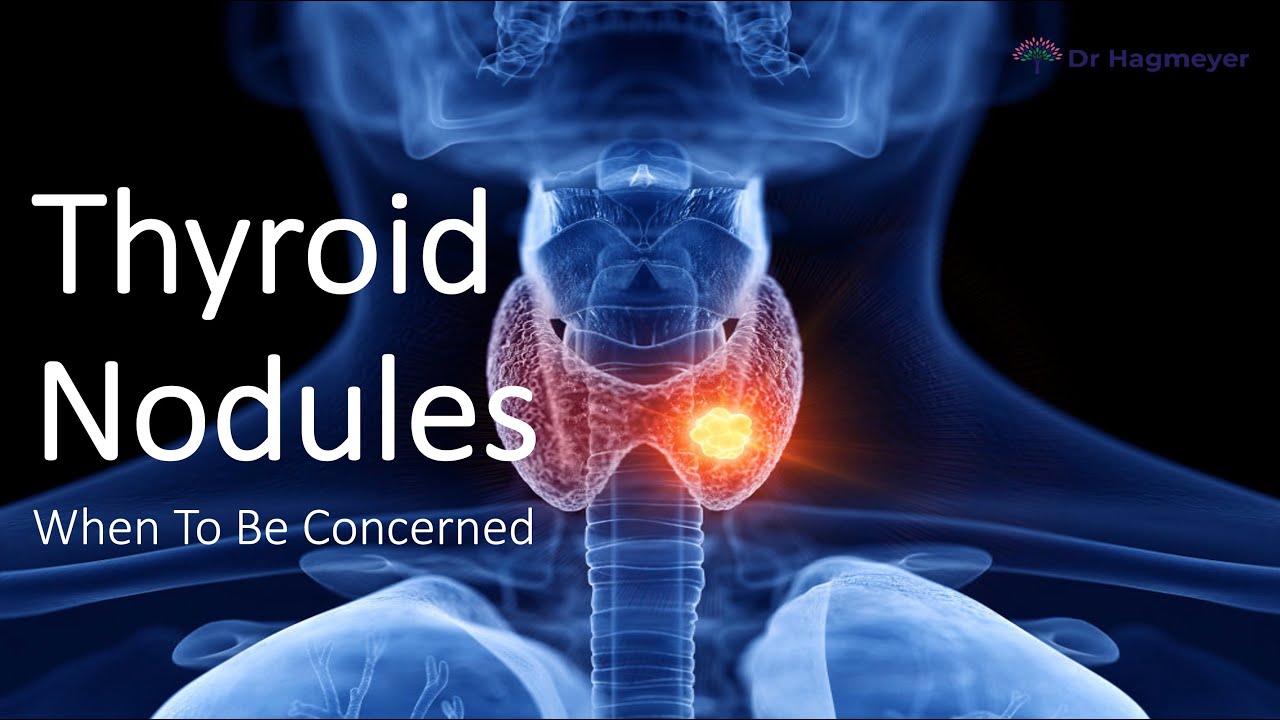 When You Need To Be Concerned About Thyroid Nodules YouTube When you need to be concerned about thyroid nodules youtube