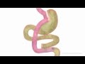 Laparoscopic gastric bypass animation