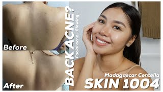 SKIN1004 MADAGASCAR CENTELLA HONEST REVIEW FOR 5 DAYS BACK & FACIAL ACNE GONE by Lhianne Lauren