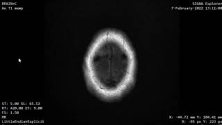 CASE 1011 MRI BRAIN CPA VESTIBULAR SHOWANOMMA ARACHNIOD CYST @educationalradiologychanne9079