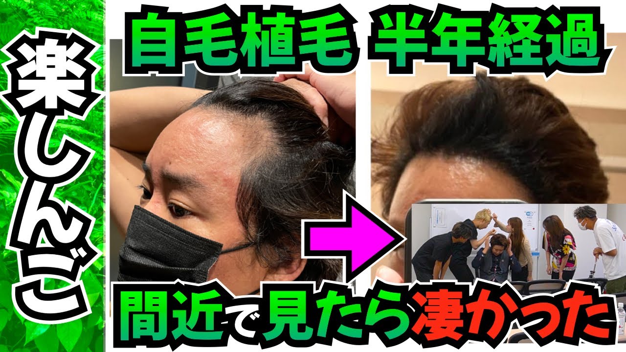 【楽しんご】自毛植毛 半年経過めっちゃ生えて来た!!【薄毛の窓口｜トルコ植毛】