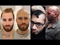 BALDING MEN EMBRACE GOING BALD - BaldCafe Head Shave *INSPIRATION!*