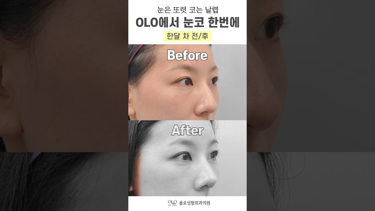 [奧洛整形外科診所] #明眸電眼! #俏麗美鼻! 於OLO #眼鼻同時塑形! #奧洛整形外科 #一次搞定 #即刻擁有 #shorts
