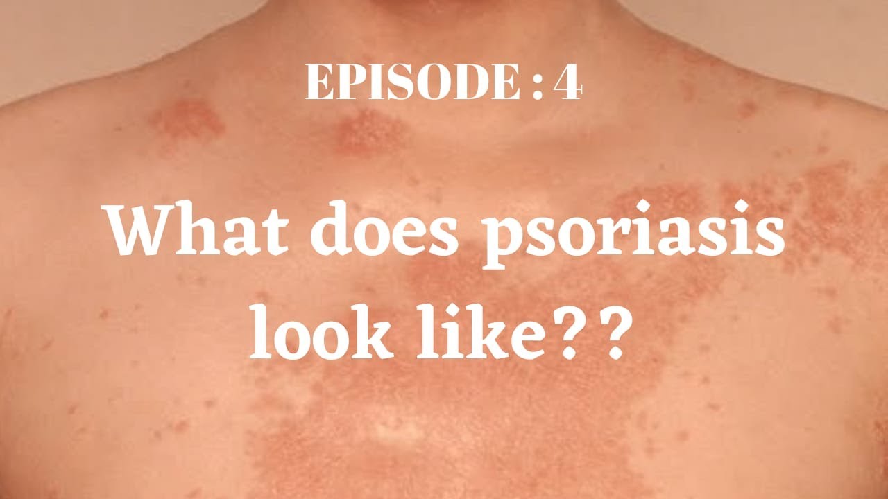 What does Psoriasis look like? YouTube