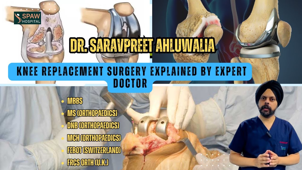 Knee Replacement Surgery Explained | Arthritis Treatment & Knee Implants by Dr. Saravpreet Ahluwalia