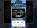 Follicular Monitoring Explained by Dr. K. Sree Lalitha | Infertility Scan at HCC Hospital