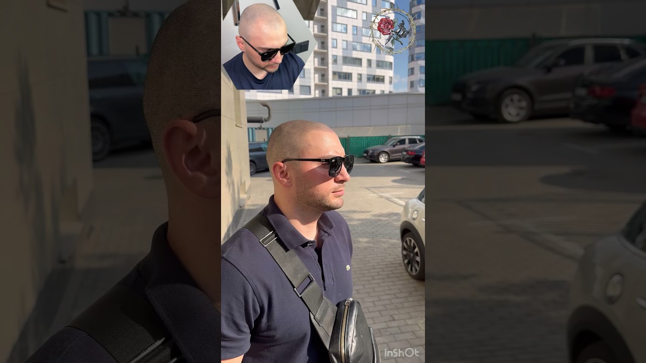 Облысения НЕТ. Трихопигментация при естественном свете. Лучше чем пересадка волос. SMP