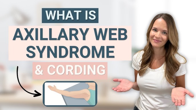 Axillary Web Syndrome (Cording)