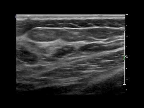 Breast Ultrasound - fat and glandular tissue