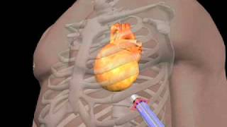 Enlarged Heart Animation