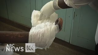 Maggot therapy experiences renaissance in African hospitals 2015 ABC News