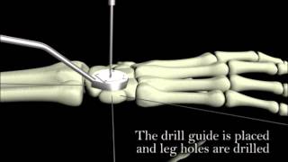 BioPro Clover Staple 4-Leg Animation