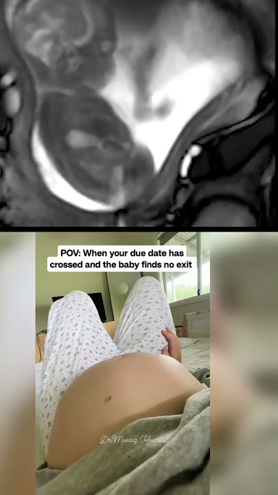 9 Months Pregnancy Ultrasound Scan